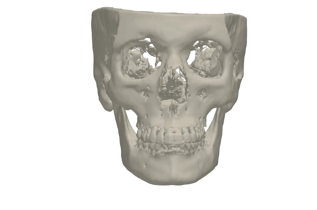 Cráneo segmentado a partir de un CBCT en tresD DICOM