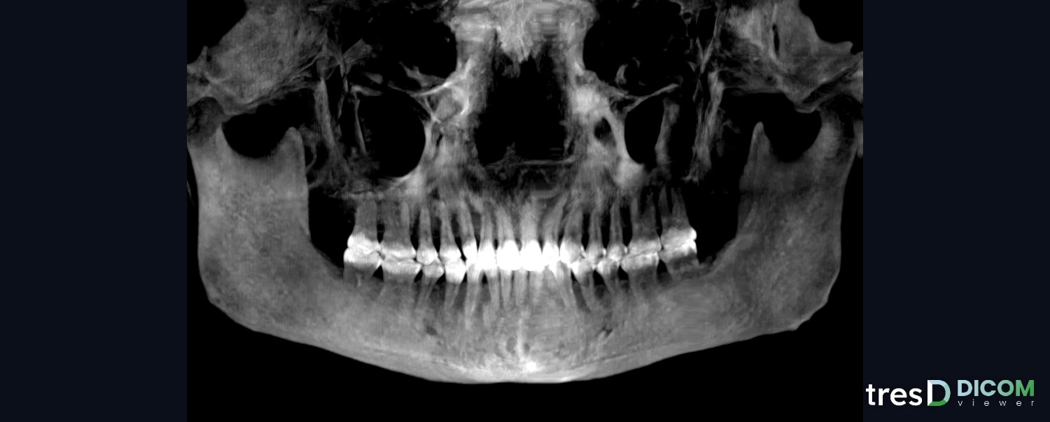 Panorámica reconstruida a partir de un CBCT en tresD DICOM