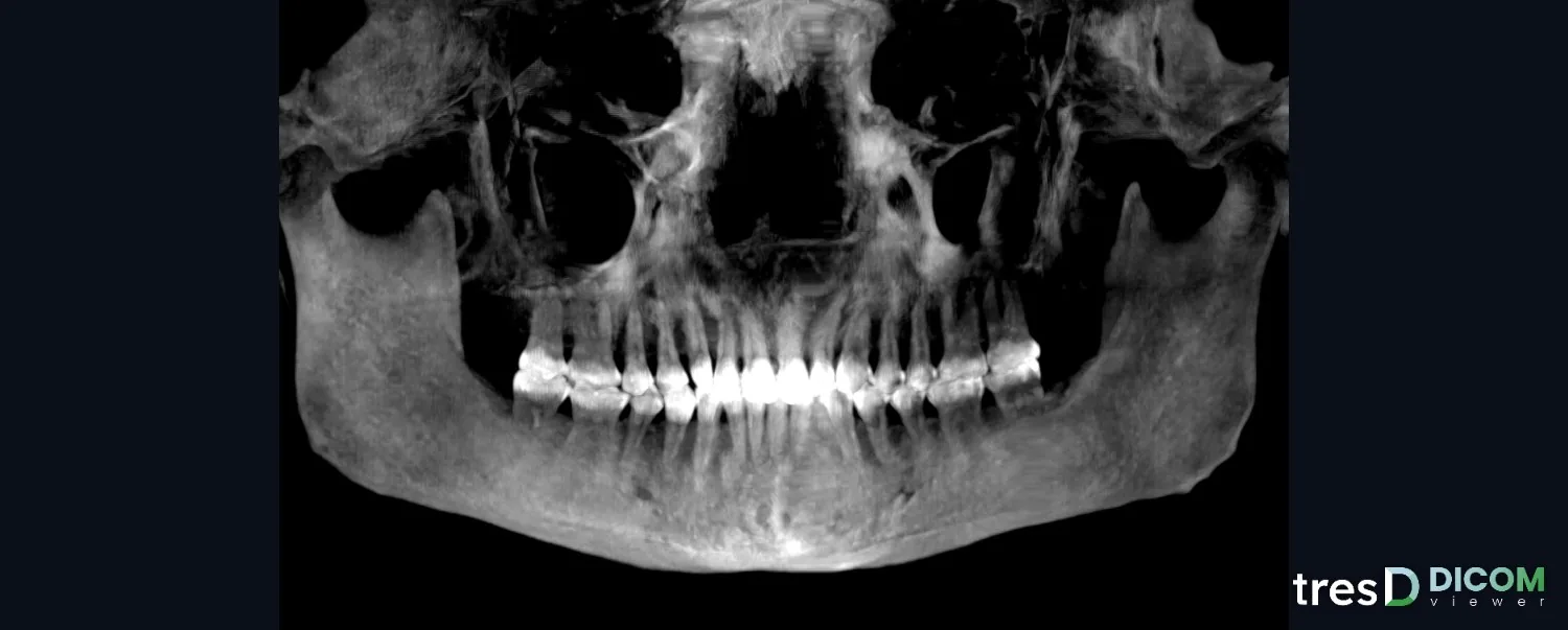 Panorámica reconstruida a partir del CBCT en tresD DICOM