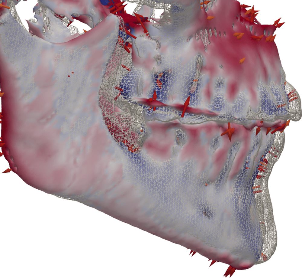 Superposición de dos CBCT con mapa de color y flechas en tresD DICOM