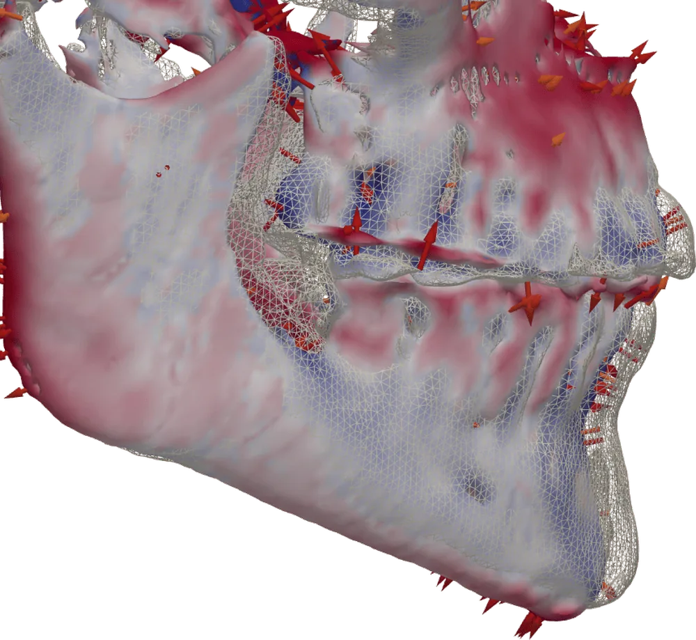 Superposición de dos CBCT con el mapa de diferencias en color y las flechas de desplazamiento