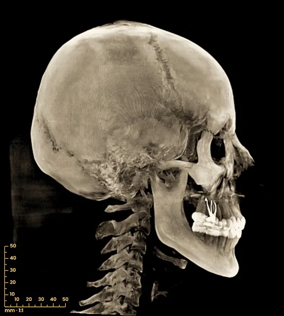 Telerradiografía lateral obtenida del CBCT con el filtro marfil en tresD DICOM