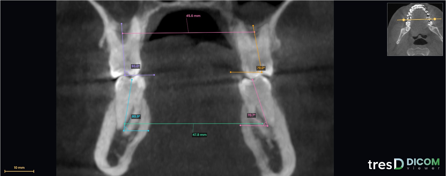 Corte transversal por los primeros molares con medidas en tresD DICOM
