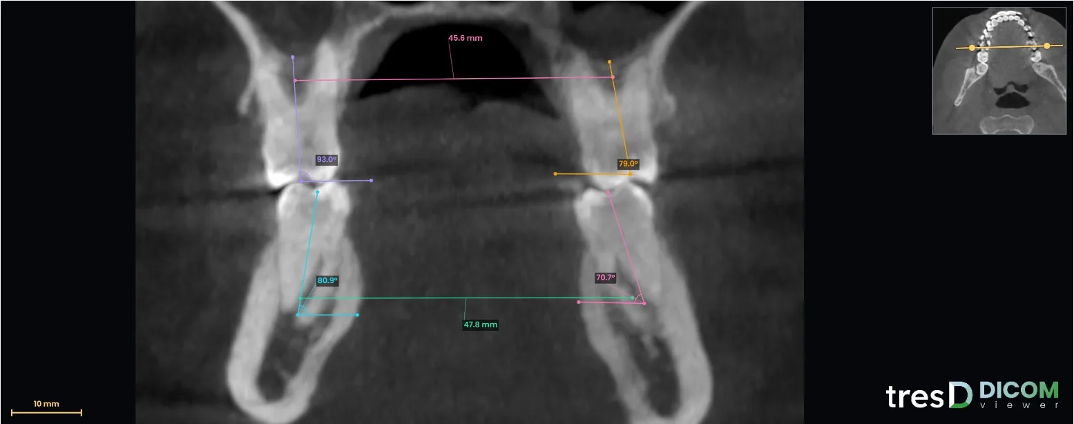 Corte transversal por los primeros molares con medidas en tresD DICOM