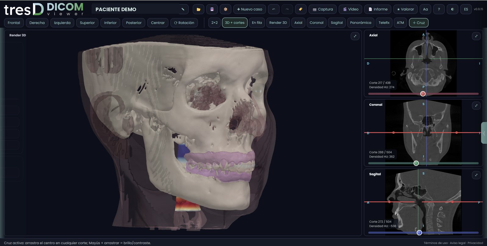 tresD DICOM con el render 3D y los cortes axial, coronal y sagital de un CBCT