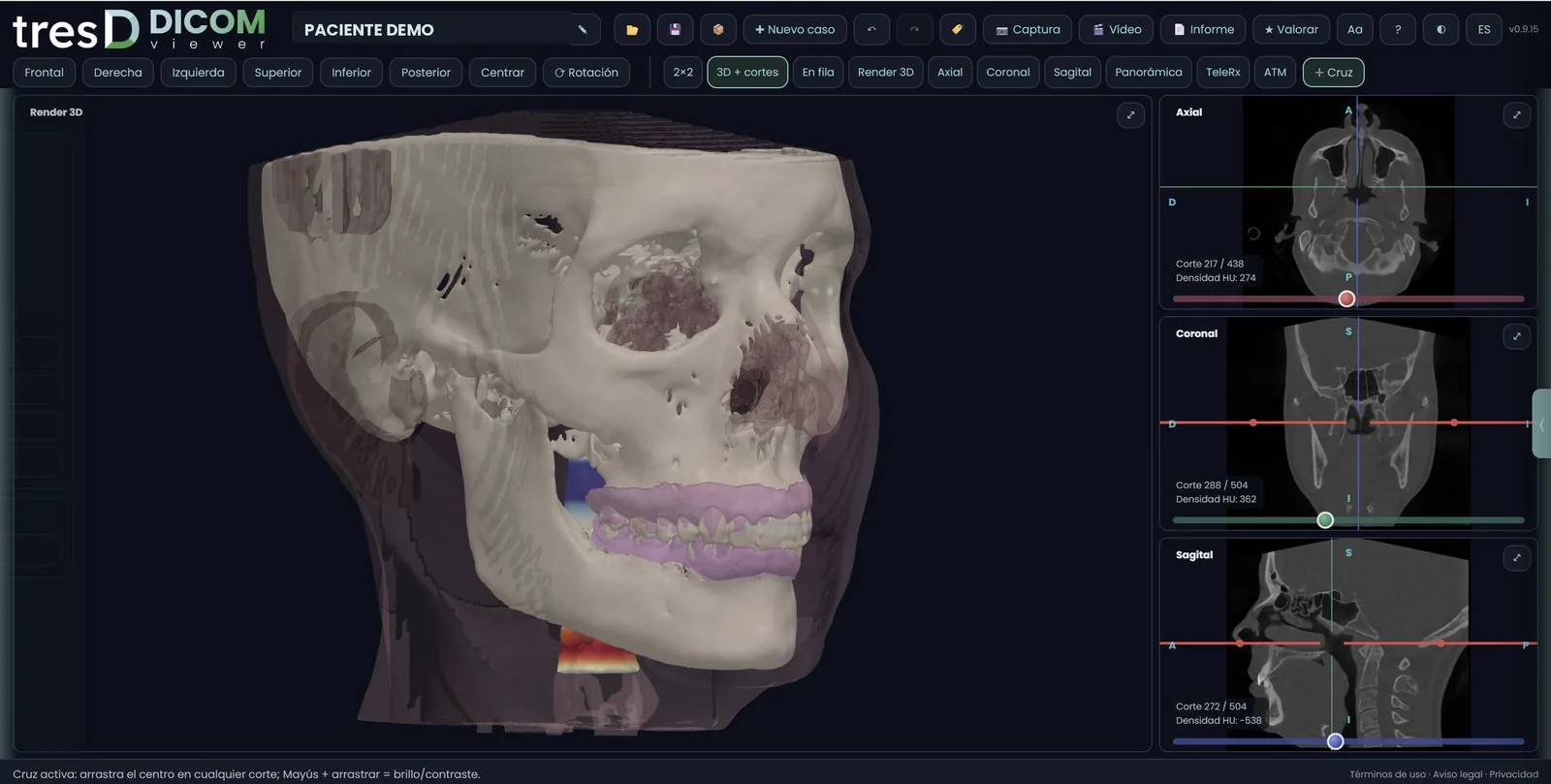 Interfaz de tresD DICOM con el render 3D y los tres cortes