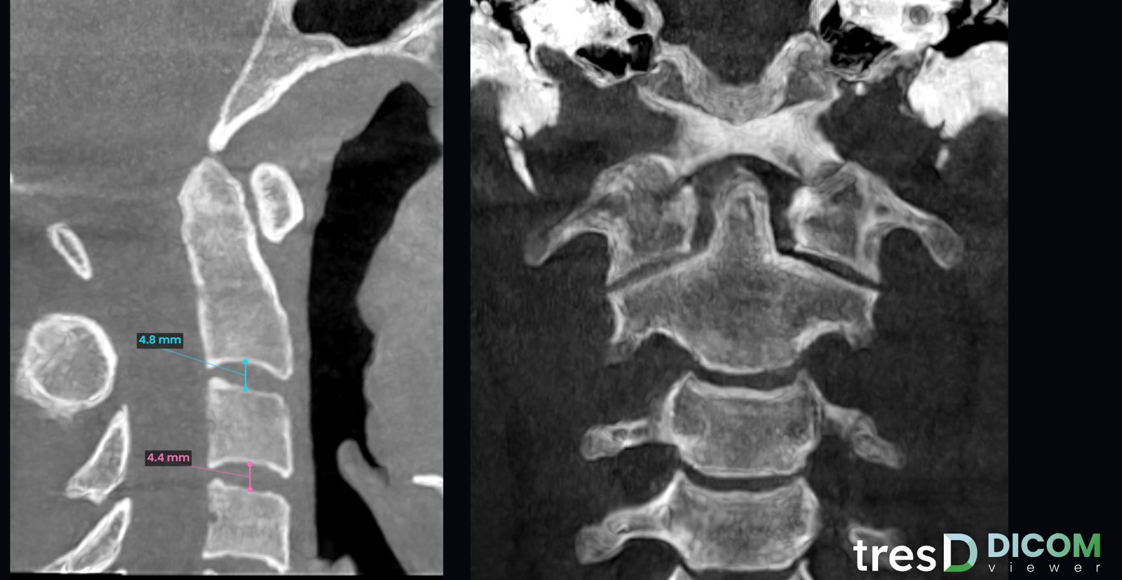 Cortes sagital y coronal de las vértebras cervicales con medidas en tresD DICOM