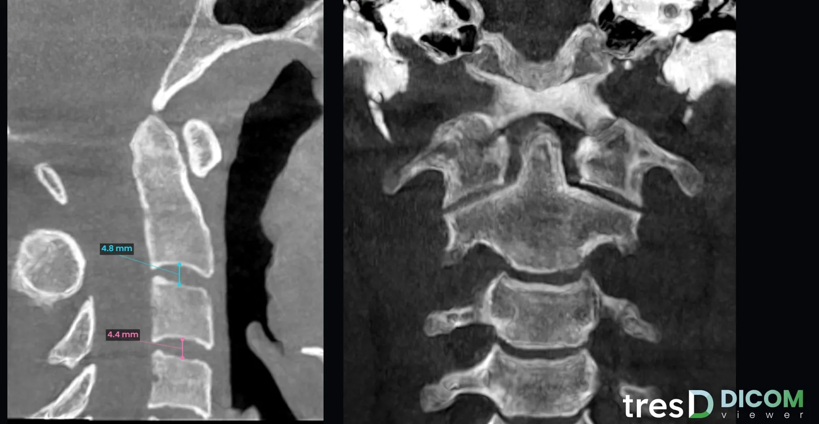 Cortes sagital y coronal de las vértebras cervicales con medidas